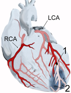 Das Bild links zeigt einen Herzinfarkt. Der Herz selbst ist darauf hellgrau zu sehen, die großen Adern, die das Herz mit Blut versorgen rot oder rosa. Beachte nun worauf der Pfeil von der Zahl 1 zeigt. Der schwarze Fleck stellt den Pfropf dar, der die Ader verschließt. Dahinter ist die Ader nicht mehr rot, sondern ohne Blut (weiß) gezeichnet. Der dunkelgraue Bereich bei der Zahl 2 zeigt den Bereich des Herzens, der abstirbt, weil er eben nicht mehr durchblutet ist.